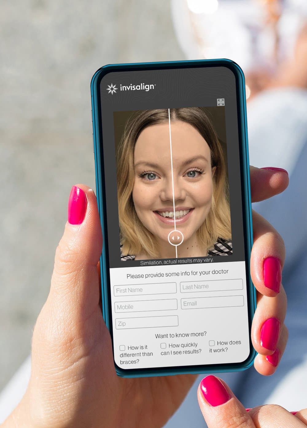 Phone showing the Invisalign SmileView before-and-after smile slider (simulation)