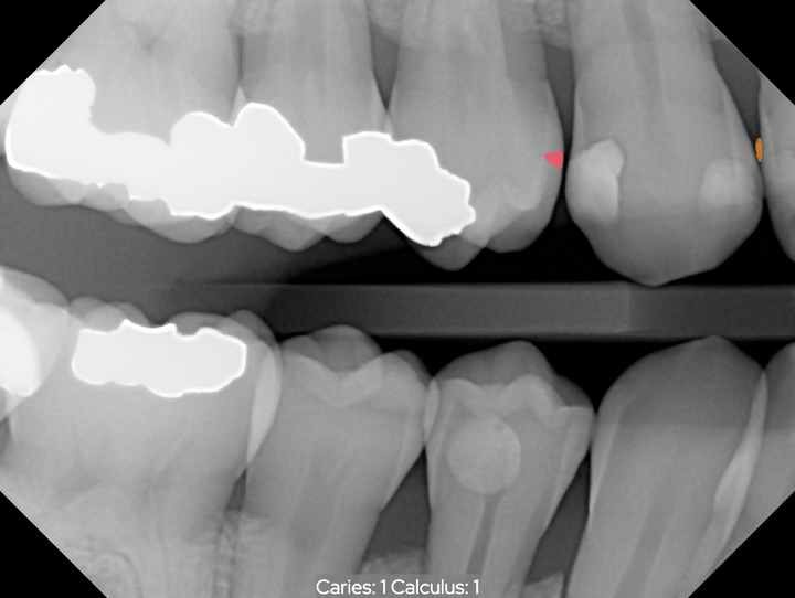 Dental X-ray with software annotations marking possible decay in red and tartar in orange