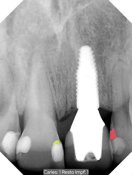 Dental X-ray with software annotations marking a gap at a filling margin in green and possible decay in red