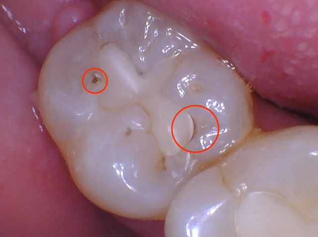 The same molar photograph with two areas circled in red
