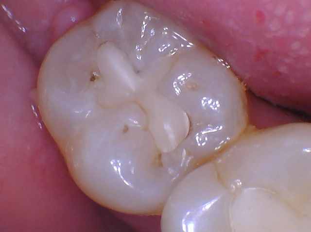 Close-up intraoral photograph of a molar