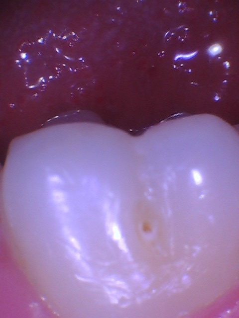 Intraoral photo of a molar with a small pit and cavity on the cheek side of the tooth