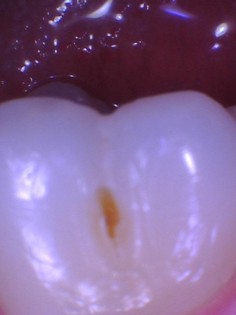 Intraoral photo of the same molar showing a brown lesion in the groove