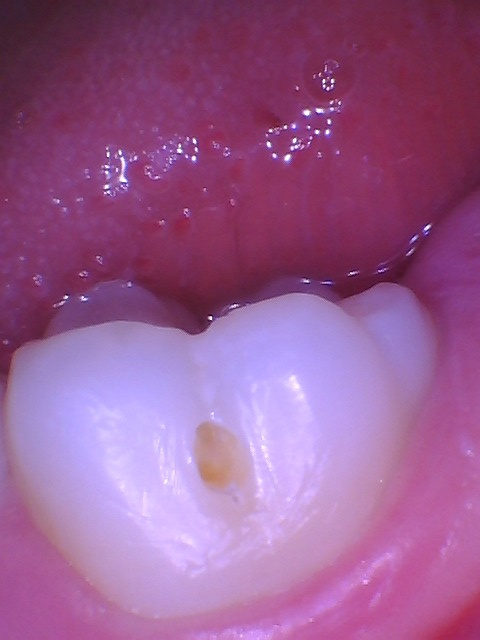 Intraoral photo of the same molar after the pit is opened, showing the cavity