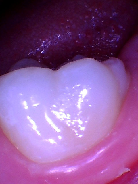 Intraoral photo of the same molar after a tooth-colored filling
