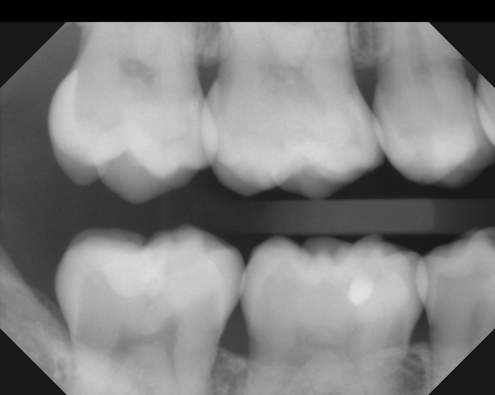 Bitewing dental X-ray showing upper and lower back teeth