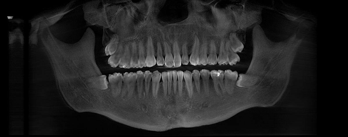 Panoramic dental X-ray showing both jaws, the teeth, and the joints