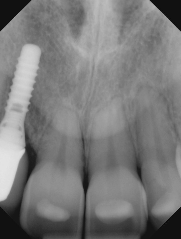 Periapical dental X-ray showing tooth roots, surrounding bone, and a dental implant